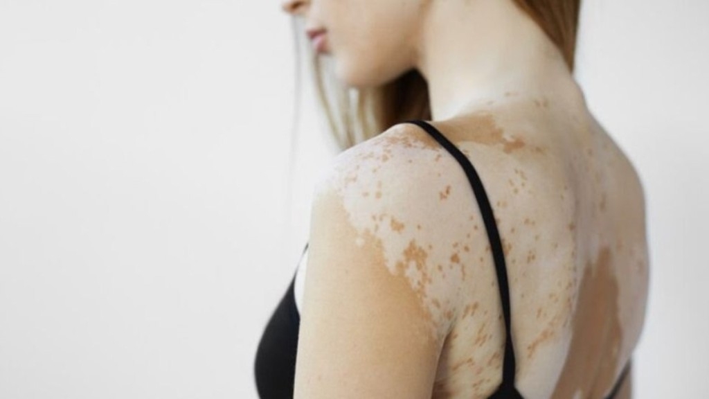 Redação GPS Vitiligo: confira dicas de cuidados especiais com a pele Redação GPS Vitiligo: confira dicas de cuidados especiais com a pele